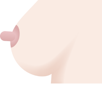 乳頭縮小