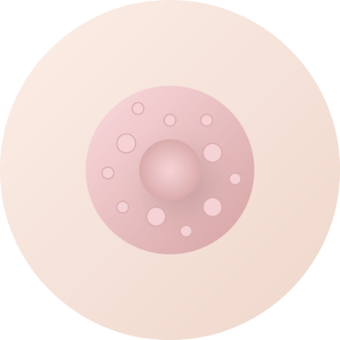 モントゴメリー線除去