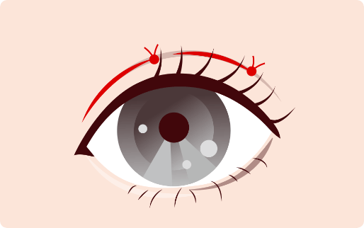 線留めのイラスト