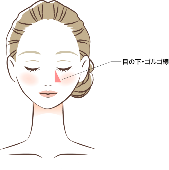 目の下〜ゴルゴ脂肪注入